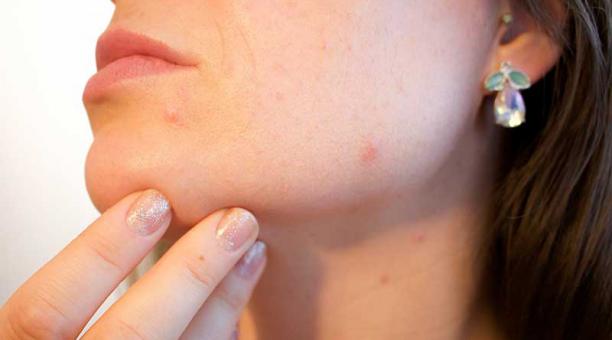 Imagen referencial. Mantener el rostro limpio  es una de los métodos que ayuda a mantener la piel libre de puntos negros. Foto: Pxhere